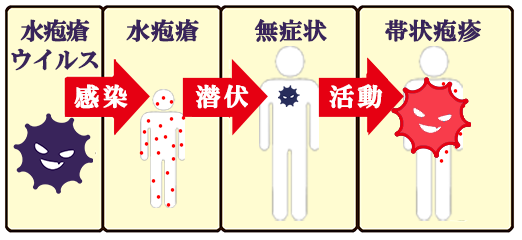 帯状疱疹のしくみ