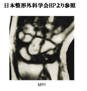 キーンベック病のレントゲン