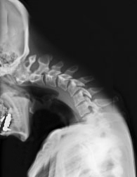 首下がり症候群