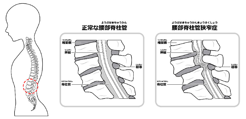 腰部脊柱管狭窄症