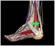 アキレス腱断裂保存療法